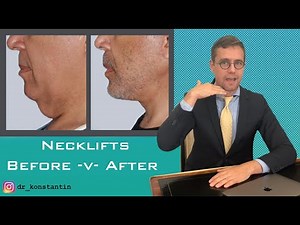 Neck Lift Transformation: Before & After