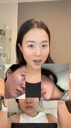 i’ve been seeing this trend on tiktok so i had to test this out myself 🤔 reviewing the pair acne cream w by lion (japanese brand) FULL REVIEW: - this product works slow so i wouldn’t rely on it if you need clear skin fast - was not pleased with how the insides of my pimples did not change. i feel like the time of using this product to get rid if a pimple vs. letting it naturally go away was only a minor difference of 1-2 days - good thing is the cream does not sting or dry out the skin #acnecre