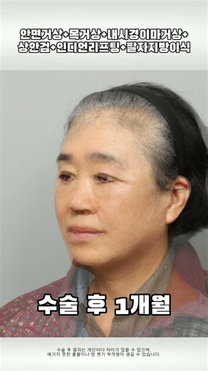 안면거상+목거상+내시경이마거상+상안검+인디언리프팅+팔자지방이식