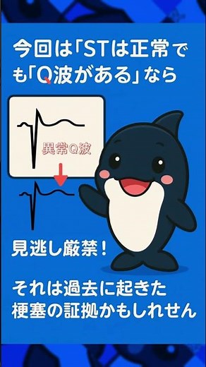 病棟でとった心電図、これは昔の梗塞のサイン！？陳旧性心筋梗塞を見抜こう！#心電図 #心電図検定 #看護師 #医学生 #看護学生 #シャチ #おすすめ