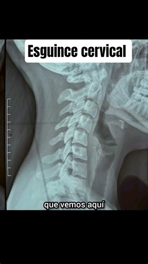 Cervical sprain or whiplash #medicine #cervicalsprain #whiplash #health