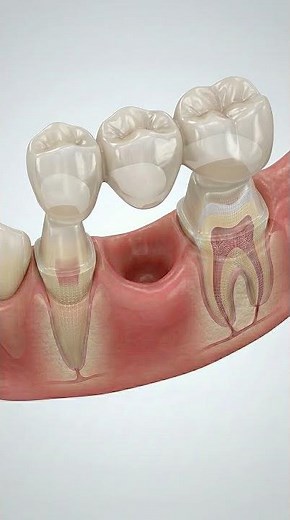 Tooth Gap Replaced with Bridge 🦷 3D Dental Animation