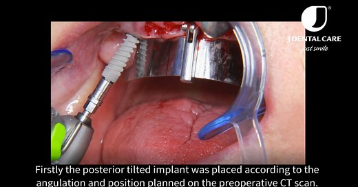 1.3K views · 36 reactions | Full arch on Four in maxilla using JDGuide and JDEvolution Implants www.jdentalcare.com #jdentalcare #jJDmplants #implantdentistry #immediateloading #foreverJD #JDEvolution #fullarch‬ #flapless #JDfamily #Madeinitaly #JDImplants #JD4 | JDentalCare | Facebook