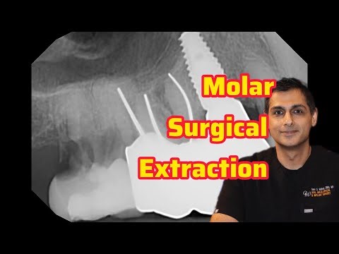 Molar Surgical Extraction