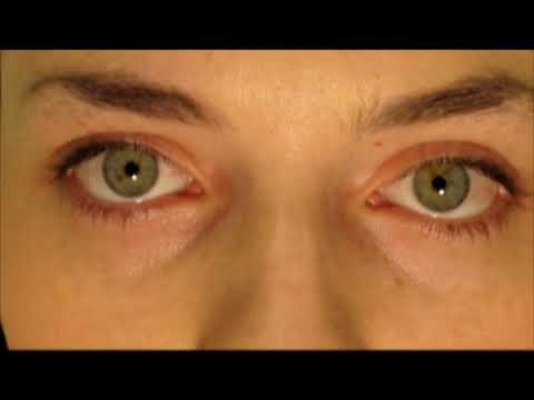 #1 Secret How to Have White, WhiterEyes®, Part 1. No More Brown, Bloodshot eyes video eye whitening
