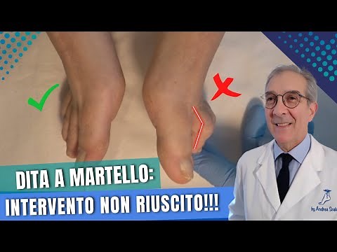 Cosa significa dita "en griffe" o a martello? | Dita a martello intervento | Dott. Andrea Scala