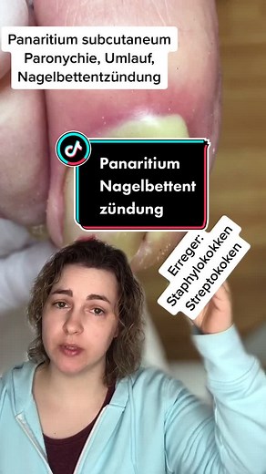 Understanding Panaritium, Paronychia, and Umlauf - Explained by Podologin Andrea