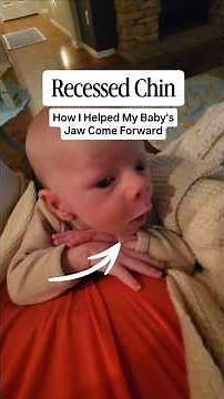 Recessed Chin in Babies - How I Helped My Baby's Recessed Jaw Come Forward #baby #mom #viral