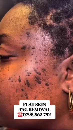 Flat Skin Tag Removal A precise medical treatment for the safe removal of flat skin tags, performed under professional care to improve skin comfort and appearance. Walk-ins and appointments are both accepted. 📍 AfyaCore Skin & Laser – Hazina Trade Center 📞 0798 362 752 / WhatsApp 0715 456 524 #SkinTagRemovalKE #MedicalDermatology #AfyaCoreSkinLaser #nairobiaesthetics