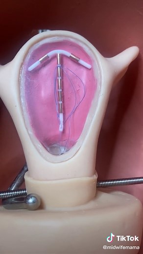 Intrauterine Device Insertion Explained: A Close-Up Look