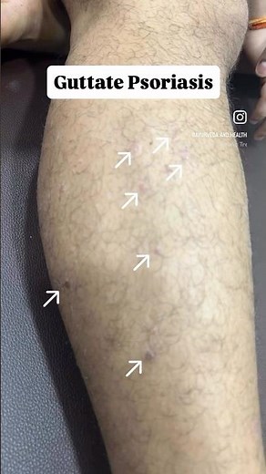 Guttate Psoriasis / Dr Jyoti Jangale