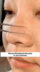 Get Rid Black Heads | Remove Blackheads Naturally In Just 2 Minutes | #shorts #skincare #beauty