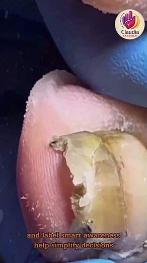 Gentle Nail Tips for Curved Nails That Reduce Pain Naturally 🪷🌸 #EverydayCare #HealthyHabits #NailCareTips | Claudia Pandolfi