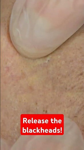 Chin Blackhead Removal – Deep Pore Cleanse! 🔬✨
