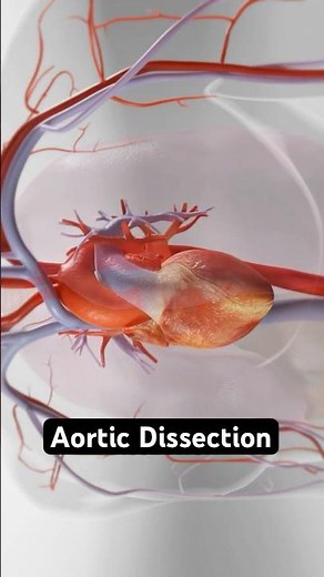 Aortic Dissection: The Chest Pain You Can’t Ignore