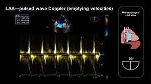 15 reactions | Evaluating the left atrial appendage for a thrombus is...