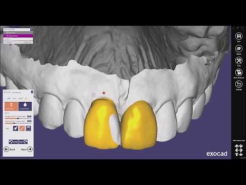how to create mock up (diagnostic wax up) with exocad