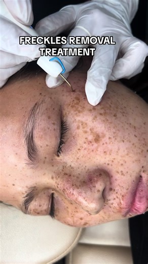 D’cosmo One Stop Solution For All Your Skin Concern. Remember us:📞9801355647 📍Kathmandu,Nepal 🏙D’cosmo Online #skin #skincare #freckle #pigmentation #fyp #foryou #foryoupage #dcosmoonline