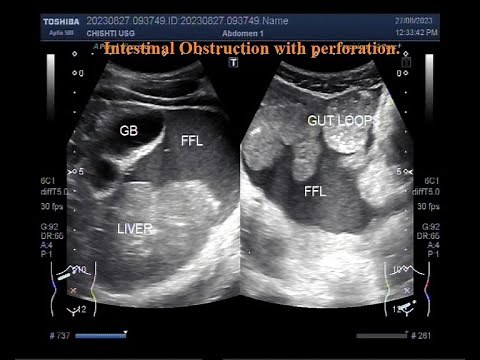 Intestinal obstruction with Perforation.