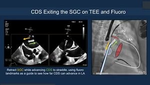 Mitral TEER Step by Step to Maximize Efficiency and Reproducibility