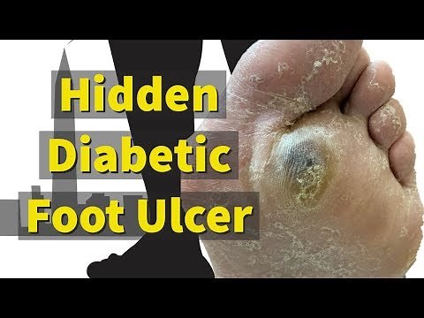 Hidden Diabetic Foot Ulcer