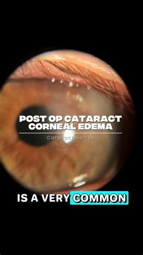 A common finding one day post op is the presence of corneal swelling or edema. This is usually due to the trauma of making incisions, inserting tools and the process of breaking up the lens. The amount of edema can vary due to time spent in surgery, the thickness of the lens and the technique used. Generally, less time means less corneal edema and faster vision recovery. Pressure elevations can also be a potential cause of corneal edema. In significant pressure spikes above 40mmHg it is potentia