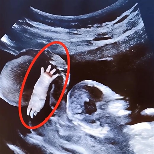 When we went for our routine ultrasound, I never imagined that day would change my life forever 😳. All previous check-ups had been normal, and the doctors always smiled and reassured us 🙂. But that morning, everything felt different. On the screen, I saw something that didn’t look like any ordinary image 👀. My heart started pounding, and I wondered if I was really seeing what I thought I was 💓. The doctor fell silent for a moment, then exchanged worried glances with his assistant. That brief