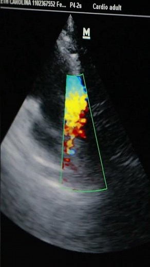 ¿Cómo es el ecocardiograma transtorácico? 👀 - Dr.Roberto expósito