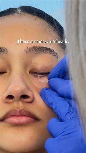 Milia Removal