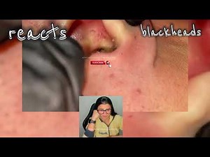 blackhead in ear, blackhead in ear removal, blackhead in earring hole, blackhead in ear extraction