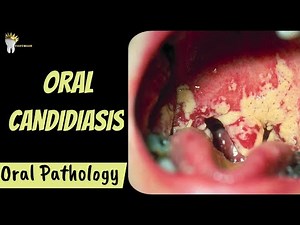 ORAL CANDIDIASIS | Diagnosis and Management | Oral Pathology