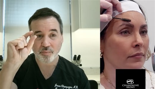 Everything You Need to Know About Eyebrow Transplants: Insights from a Top Surgeon