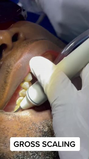 Satisfying Calculus Removal for Better Oral Hygiene