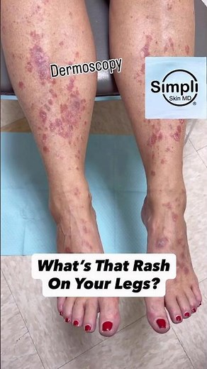 What’s That Rash On Your Legs? Come See What Your Dermatologist Sees!