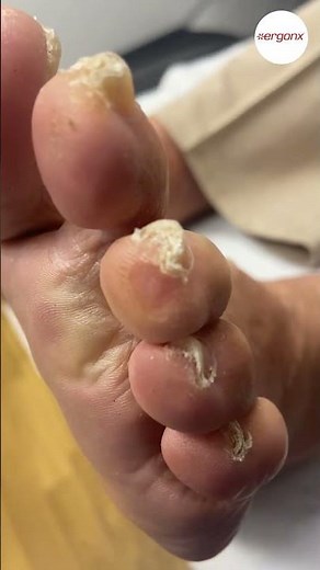 Avoid Painful Toe Corns: Tips for Choosing the Right Work Boots #FootCare #WorkBoots