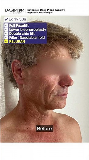 Facelift+Rejuran: Achieving a Natural, Youthful Look #facelift #beforeandafter #deepplane #Rejuran