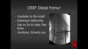 Distal Femur Fractures: ORIF