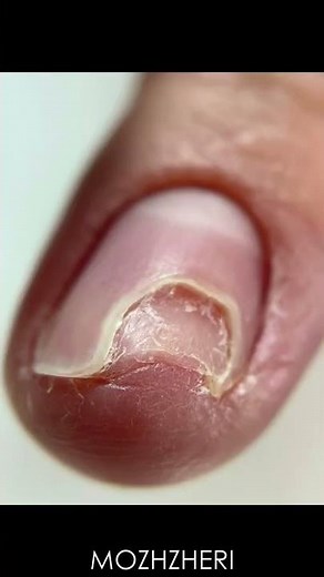 Onycholysis, MOZHZHERI