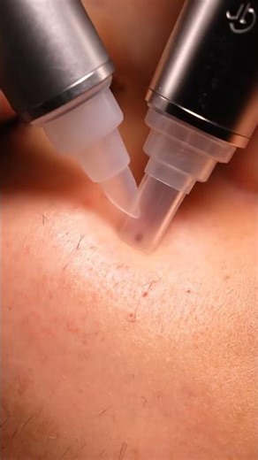 Cheek Blackhead Suction | Ultra Realistic ASMR Extraction 061