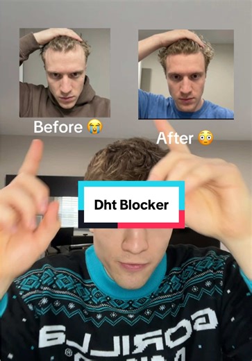 Effective DHT Blockers for Hair Growth