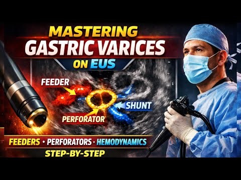 EUS Secrets for Gastric Varices | What Experts Actually Do