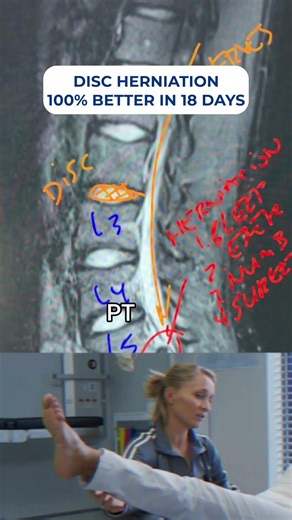 Spinal decompression fixes severe disc herniation: pain-free in 19 days! #BackPainRelief