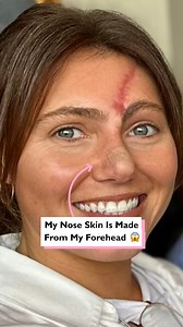 My nose had to be replaced with my forehead skin after a dog bite 😱 | Four Nine
