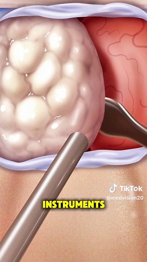 Endoscopic Transnasal Transsphenoidal Surgery Explained