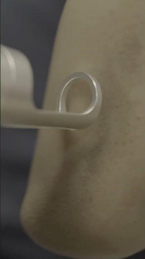 Q-Switched Laser: A Game Changer for Full-Body Pigmentation ✨