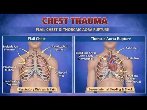 Trauma Thorax Lecture: Flail Chest & Thoracic Aorta Rupture Explained | Chest Trauma Surgery