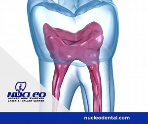 Root canal treatment is needed when dental X-rays show that the pulp has been damaged by a bacterial infection. The pulp may become inflamed if it's infected by bacteria, allowing the bacteria to multiply and spread. Phone: 915 308 0101 nucleodental.com . #NucleoDental #ElPasoTx #CiudadJuarez #NewMexico #dentalclinicnearme #oralcare #oralhealth #dentaltourism #dentaltourismmexico #dentalimplantsmexico #dentalimplantsjuarez #bestdentalserviceintown #cosmeticdentistry #dentalservice #orthodonticse