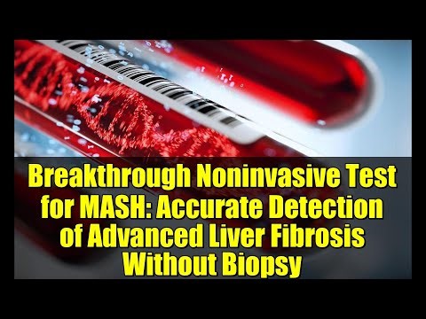 Breakthrough Noninvasive Test for MASH: Accurate Detection of Advanced Liver Fibrosis Without Biopsy