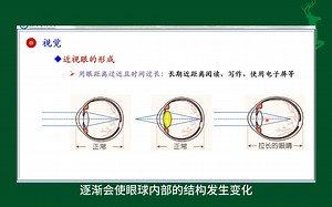 #近视眼的形成#视觉#感觉器官的功能#人体生理学#医学知识科普#每天学习一点点_哔哩哔哩_bilibili