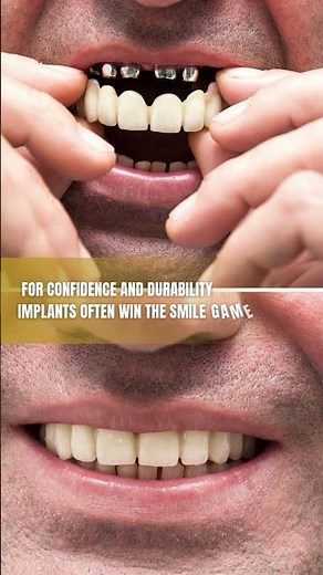 🦷 Implant-Supported Bridges vs. Dentures Compared ⚖️